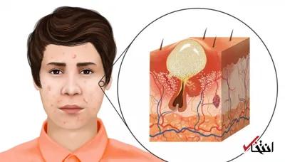 رفع آکنه های صورت با چند روش ساده
