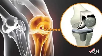 برترین روش ها برای درمان آرتروز / از پیاده روی تا کاهش وزن